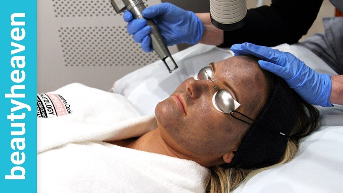 We try: The Hollywood Laser Peel