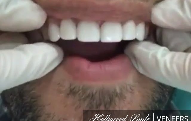 Dental Veneers & Lumineers Hollywood Smile Makeover By Montreal International Clinic Dubai, UAE